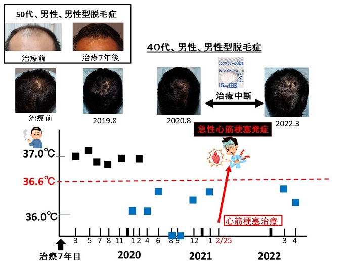 円形脱毛症　病院